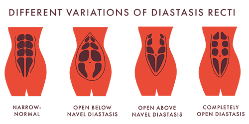 Different Variations of Diastasis Recti.